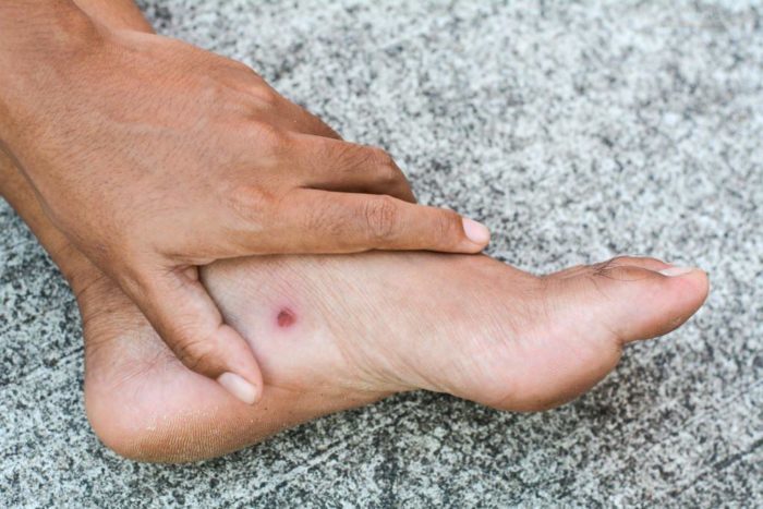complications des ulcères diabétiques du pied