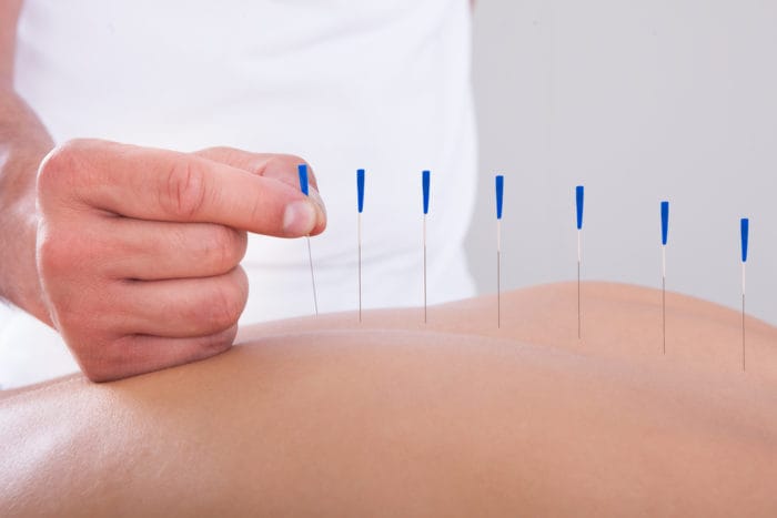 l'acupuncture soulage la douleur