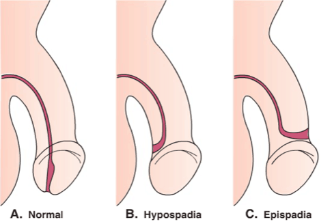 le trou du pénis n'est pas normal, épisodes d'hypospadias
