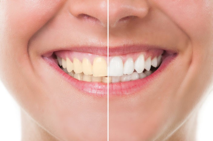 Effets secondaires du blanchiment des dents avec blanchiment