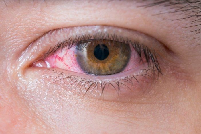 conjonctivite allergique aux yeux rouges