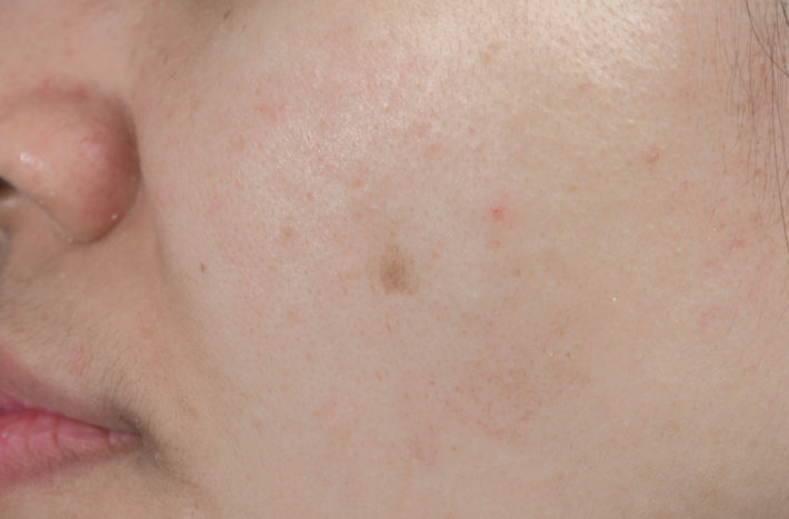 comment se débarrasser des cicatrices d'acné taches noires