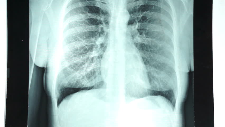 radiographie pulmonaire