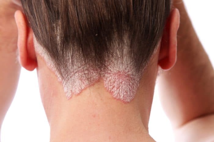 psoriasis infectieux n'est pas